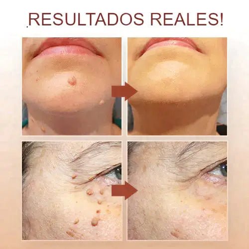 Kit Eliminador de Verrugas ⭐⭐⭐⭐⭐ - Noah Tienda